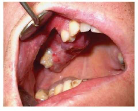 Фото: остеогенная саркома челюсти