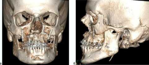 Резекция верхней челюсти
