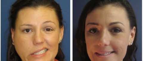 Травматический неврит после повреждения лицевого нерва