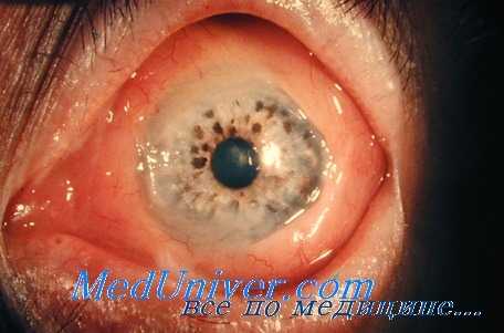 злокачественная лимформа глаза