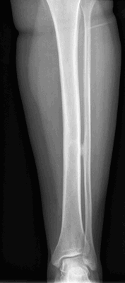 Экзостоз большеберцовой и малоберцовой кости