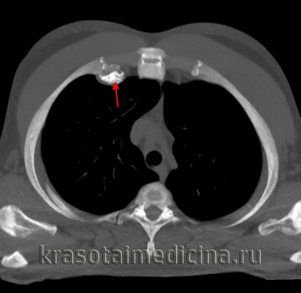 КТ ОГК. Остеохондрома 4-го ребра справа с типично костно-хрящевой «шапочкой» и ножкой.