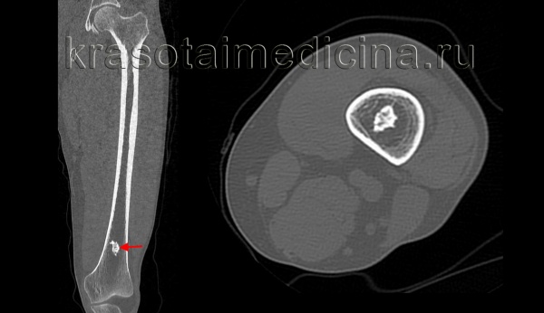 Остеохондрома