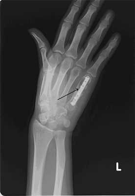 Рис. 2 б) Рентгенограмма левой кисти в прямой проекции больной Я. после оперативного лечения спустя 3 дня (стрелкой указана зона выполненной операции с наличием металлофиксатора).