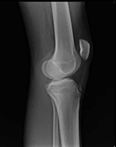 Отрыв фрагмента кости [17]