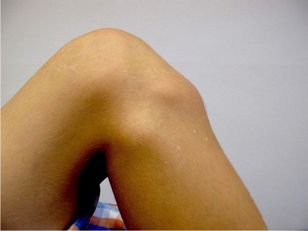 Бугорок под коленом [18]