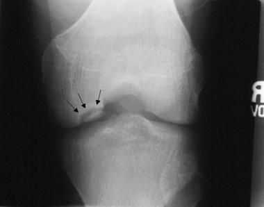 Узкая суставная щель