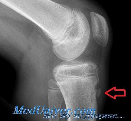 болезнь Осгуда-Шлаттера