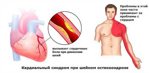 Кардиальный синдром