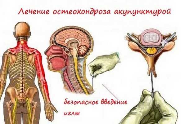 Лечение акупунктурой