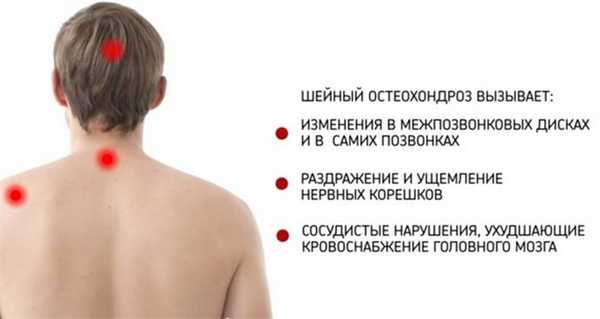 Синдромы остеохондроза