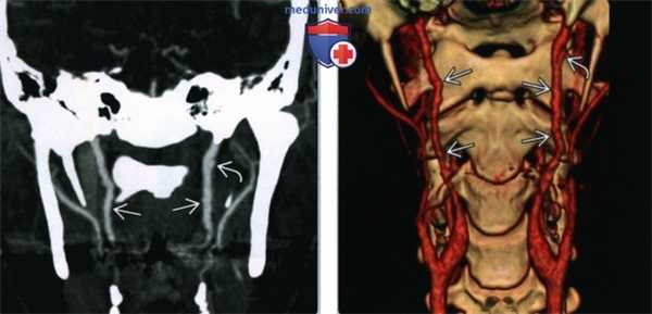 Псевдоаневризма сонной артерии - лучевая диагностика
