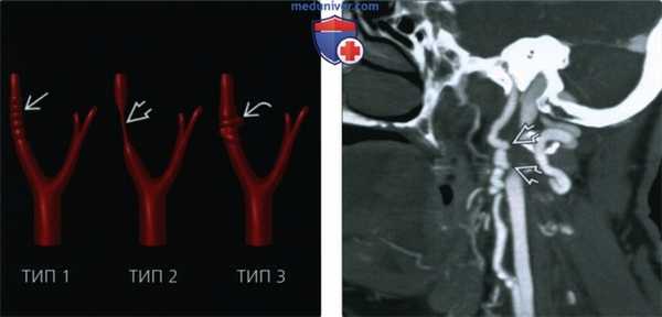 Фиброзно-мышечная дисплазия сонной артерии - лучевая диагностика