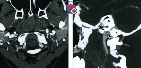 Псевдоаневризма сонной артерии - лучевая диагностика