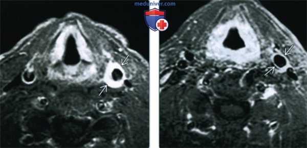 Острая идиопатическая каротидиния - лучевая диагностика