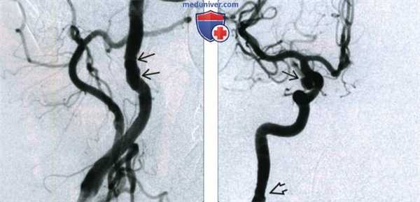 Фиброзно-мышечная дисплазия сонной артерии - лучевая диагностика