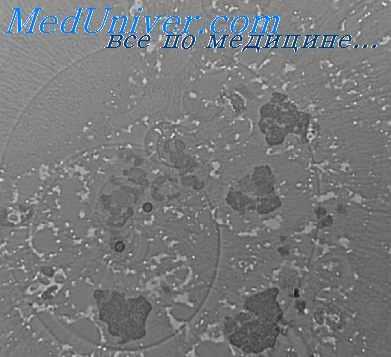 лучевое поражение печени