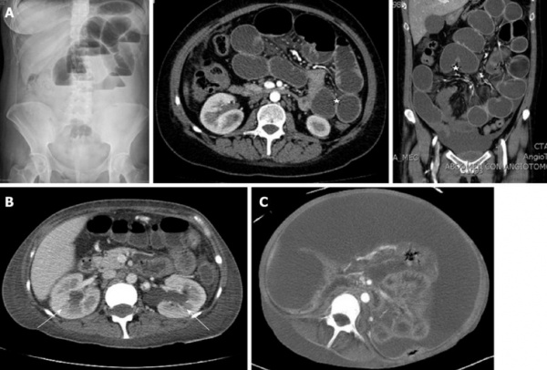 Визуализирующие исследования интестинальной псевдообструкции