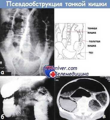 Псевдообструкция тонкой кишки