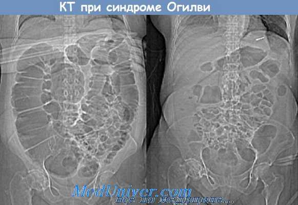 КТ при синдроме Огилви