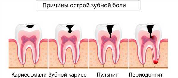 острая зубная боль 1.jpg