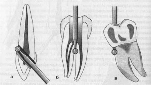 Перфорации стенок, дна камеры пульпы