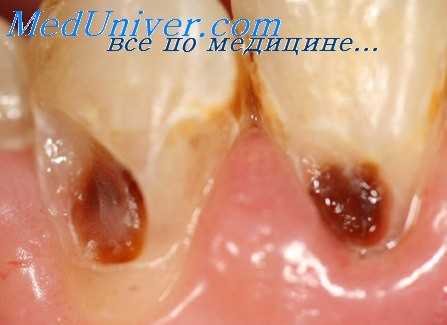 инфекции полости рта