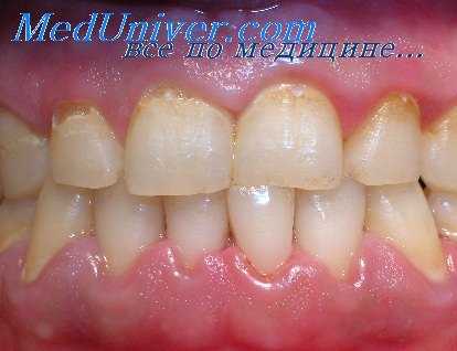 инфекции полости рта