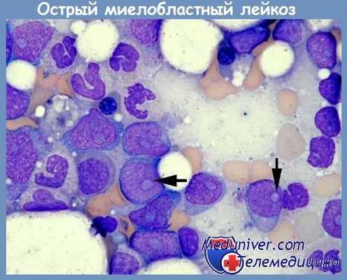острый миелобластный лейкоз