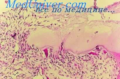 инфекционный ревматизм