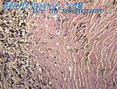 карциноматозный лимфангиоз