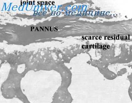 ревматизм легких