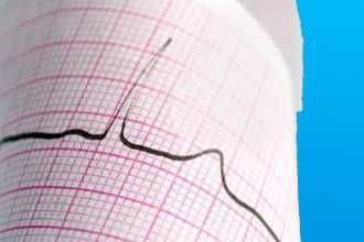 Электрокардиограмма