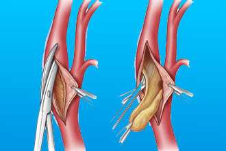 Коронарография