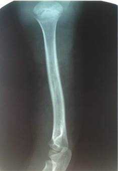 Остеомиелит у детей