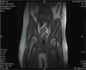 Остеомиелит у детей