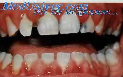 Гипертрофия десен