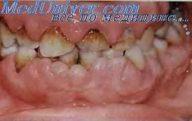 Гипертрофия десен