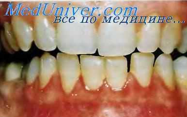 Актиномикотический гингивит.