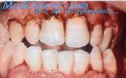 Острый язвенно-некротический гингивит