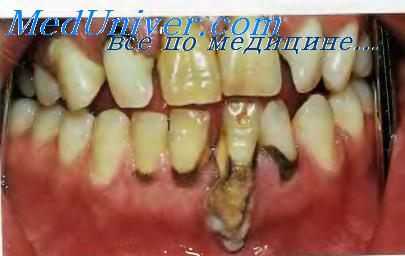 Рецессия десны