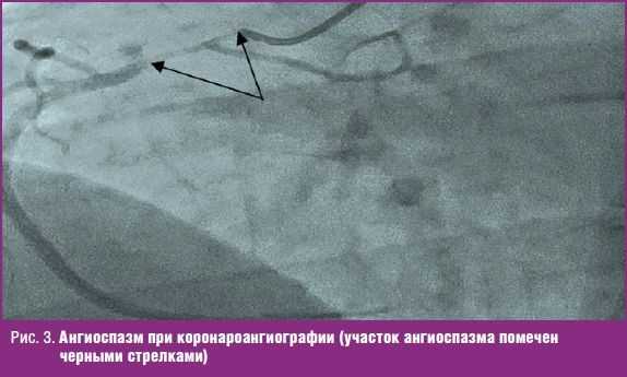 Ангиоспазм при коронароангиографии