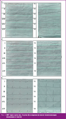 ЭКГ через сутки