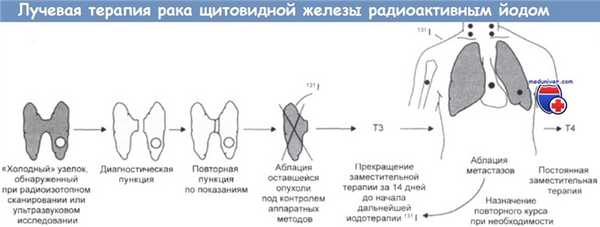 Лучевая терапия рака щитовидной железы
