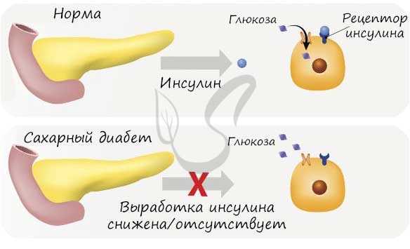 Сахарный диабет