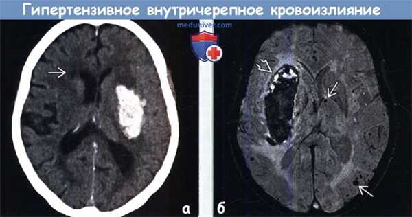 Гипертензивное внутричерепное кровоизлияние на КТ, МРТ