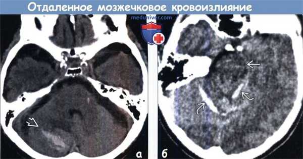 Отдаленное мозжечковое кровоизлияние на КТ