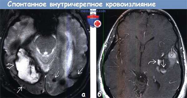 Спонтанное внутричерепное кровоизлияние на МРТ