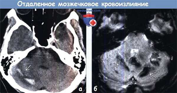 Отдаленное мозжечковое кровоизлияние на КТ, МРТ
