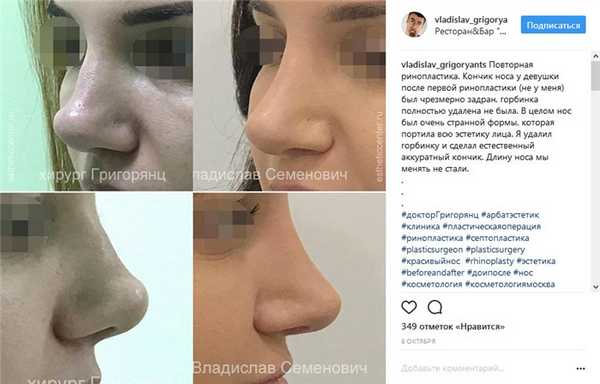 Повторная ринопластика кончика носа